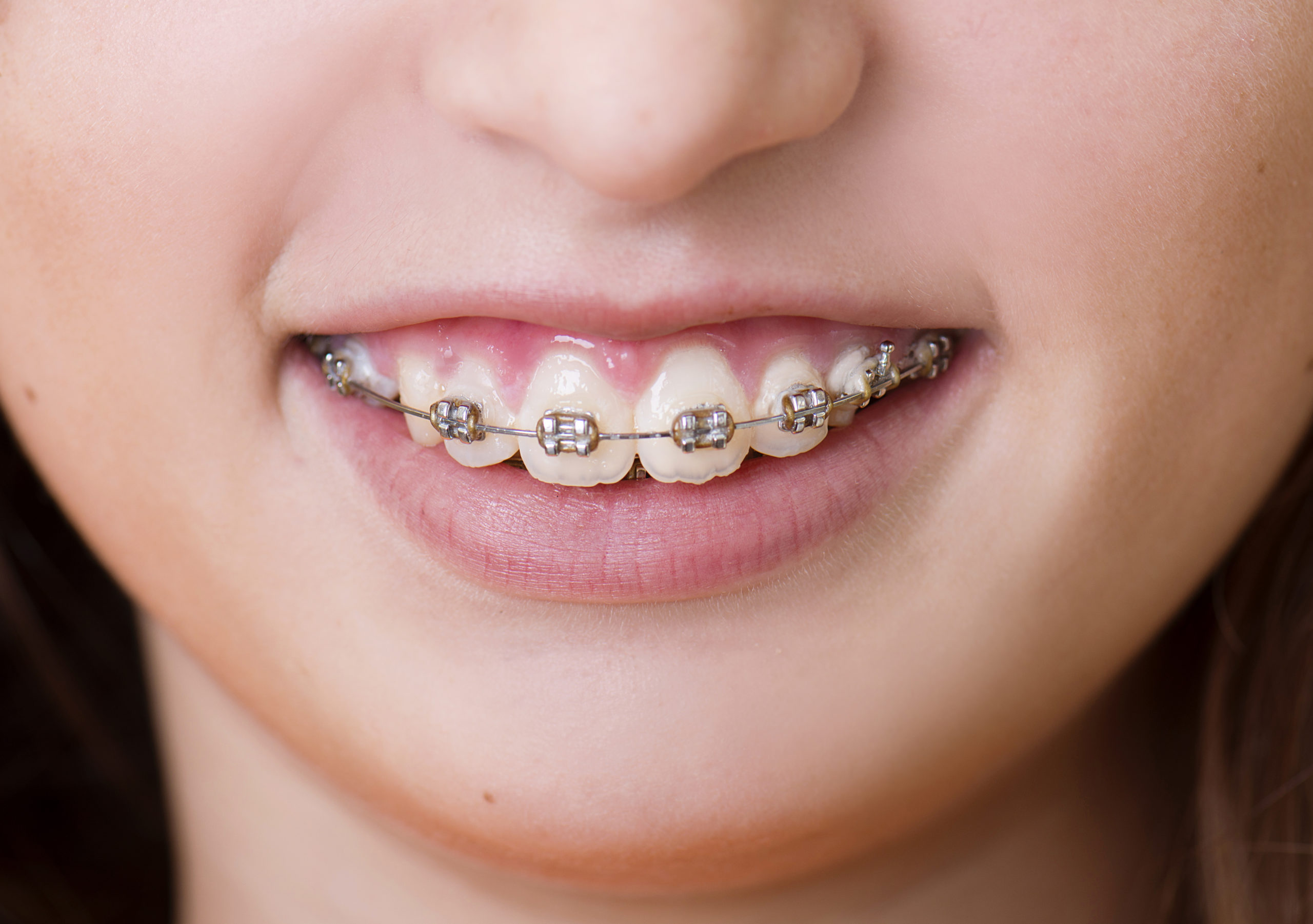 Braces, Asap? How Long Does It Really Take To Get Them On? - m92dpxj