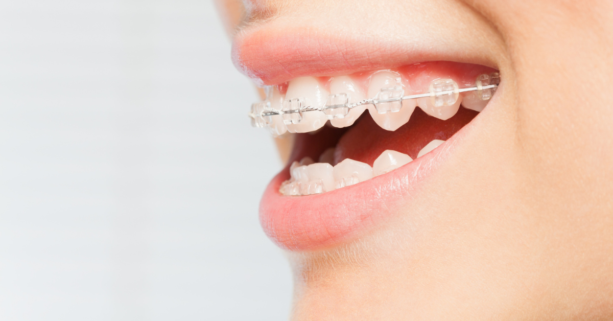 Ceramic Braces vs Metal Braces - Which is Right for You