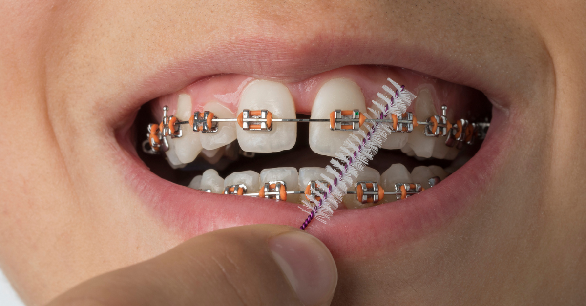 Close-up of a smiling mouth with orange braces and a person using an interdental brush to clean between the brackets, emphasizing dental hygiene.