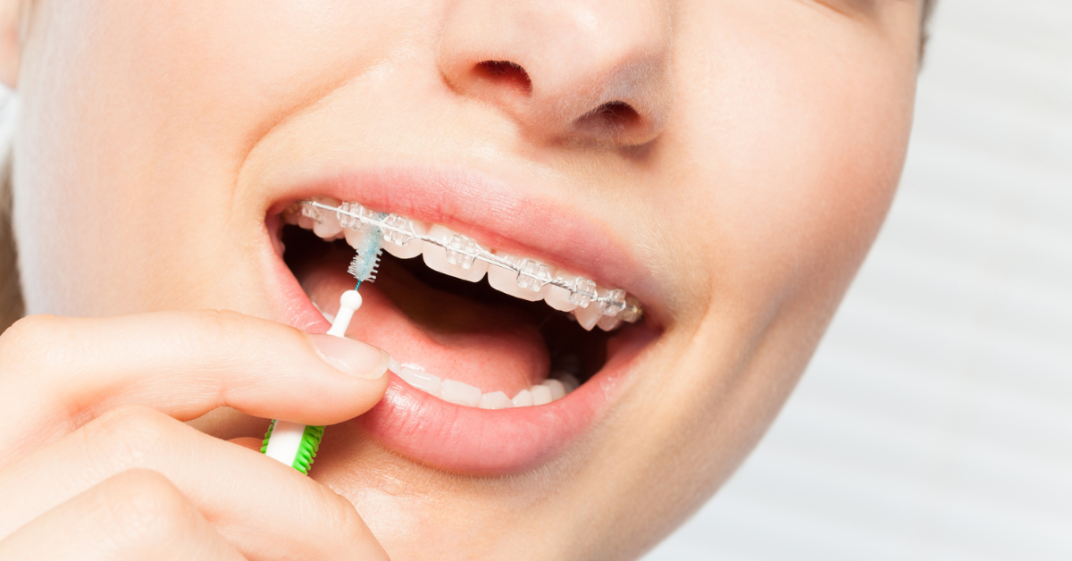 Close-up of a person cleaning teeth with braces using an interdental brush. The image conveys a sense of dental hygiene and care.