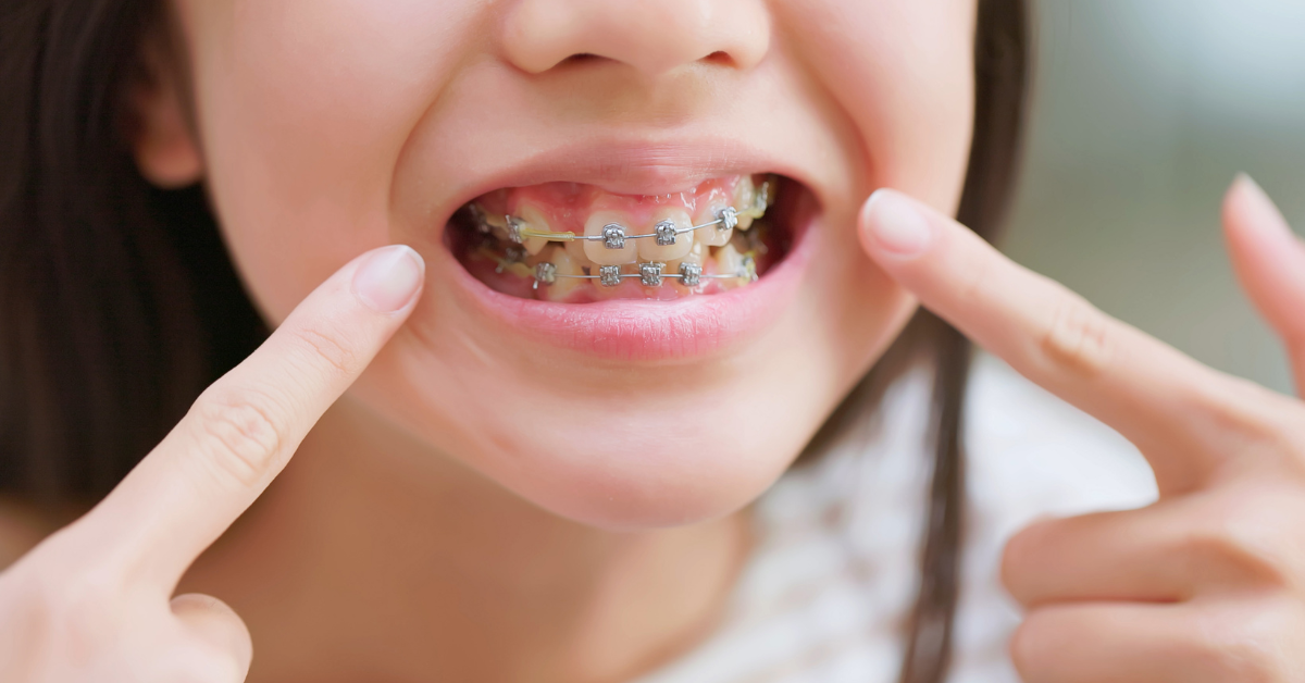 Learn how to get braces covered by medical insurance. Smileyville Braces in Louisville explains qualifying conditions, documentation tips, and coverage steps.