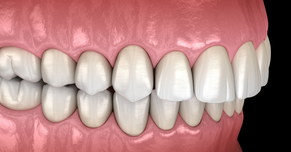 3D rendering of a dental deep bite or overbite showing misaligned upper and lower teeth. The image focuses on shiny white teeth against pink gums.