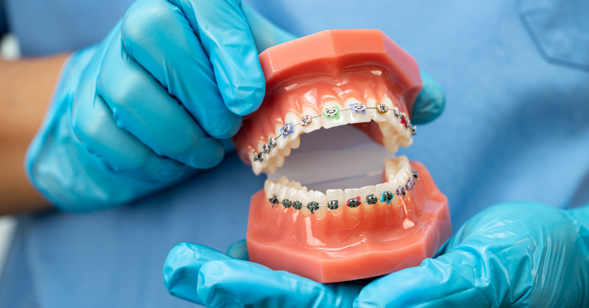 Does Dental Insurance Pay For Braces