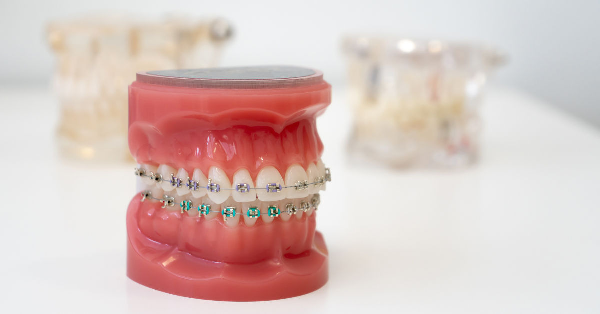 Dental model with metal braces showing brackets, wires, and colorful bands during orthodontic treatment.